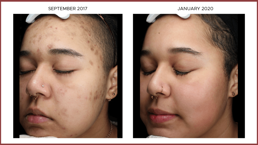 Before After Photos: Tranexami